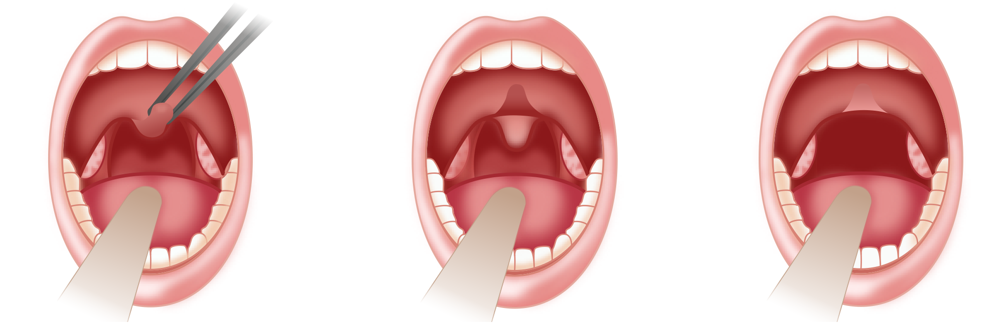 Medical_Images_2_evaluating_therapies_shortening_the_uvula